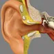 What Is the Success Rate of Cochlear Implant?