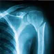 How Painful Is a Broken Humerus?